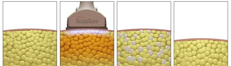 无痛瘦身!激光溶脂让你三天瘦10斤