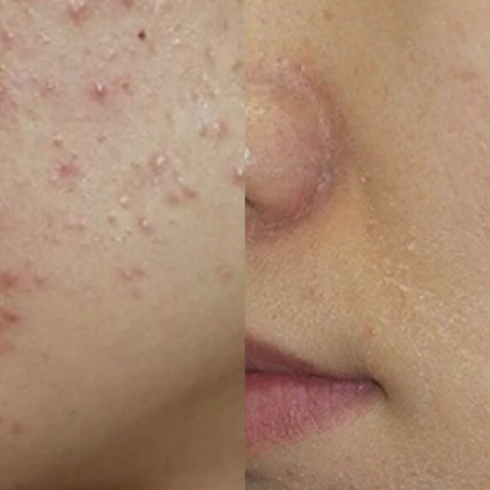 Fraxel点阵激光-before-after-3-768x384