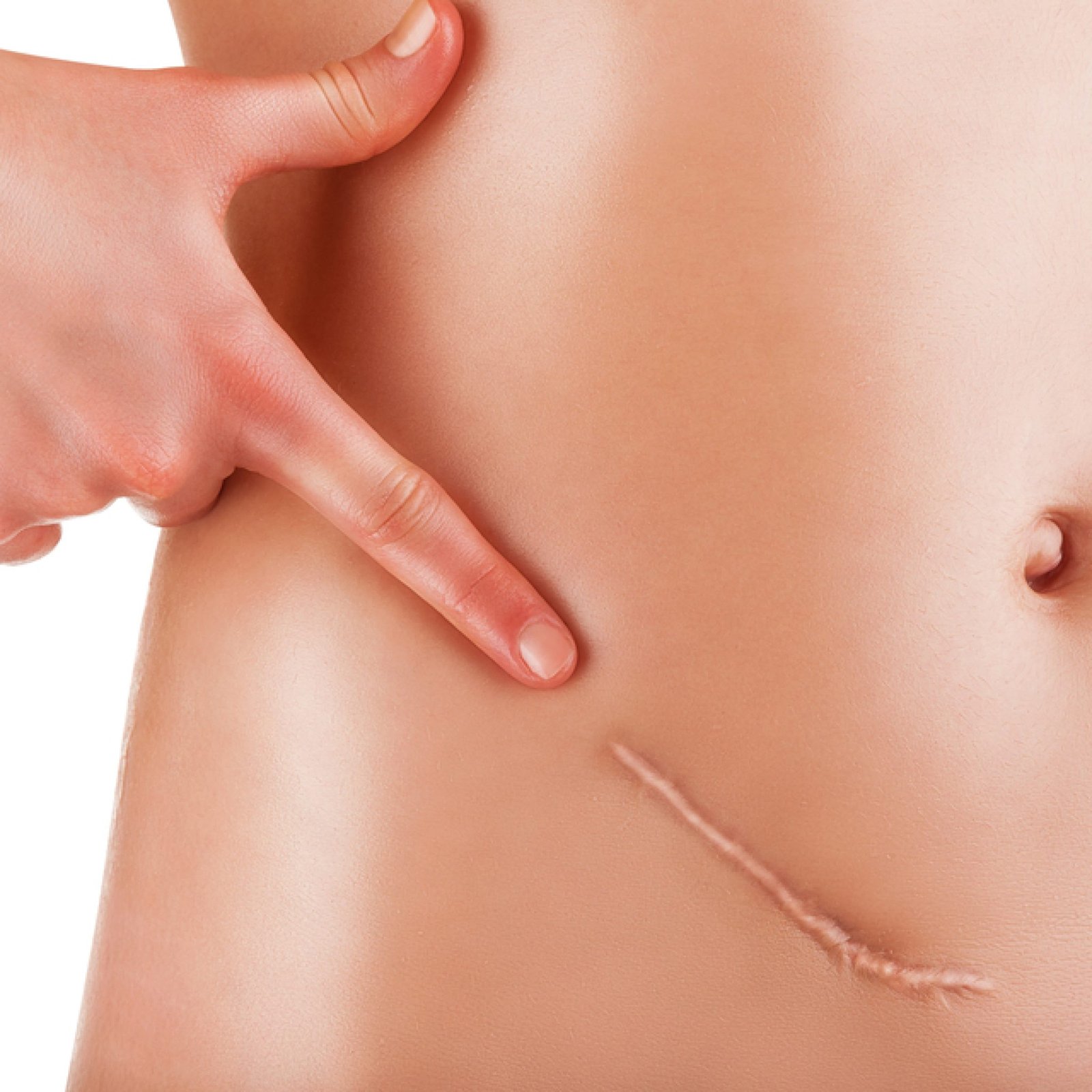 Closeup,Of,Woman,Showing,On,Your,Stomach,With,A,Scar.